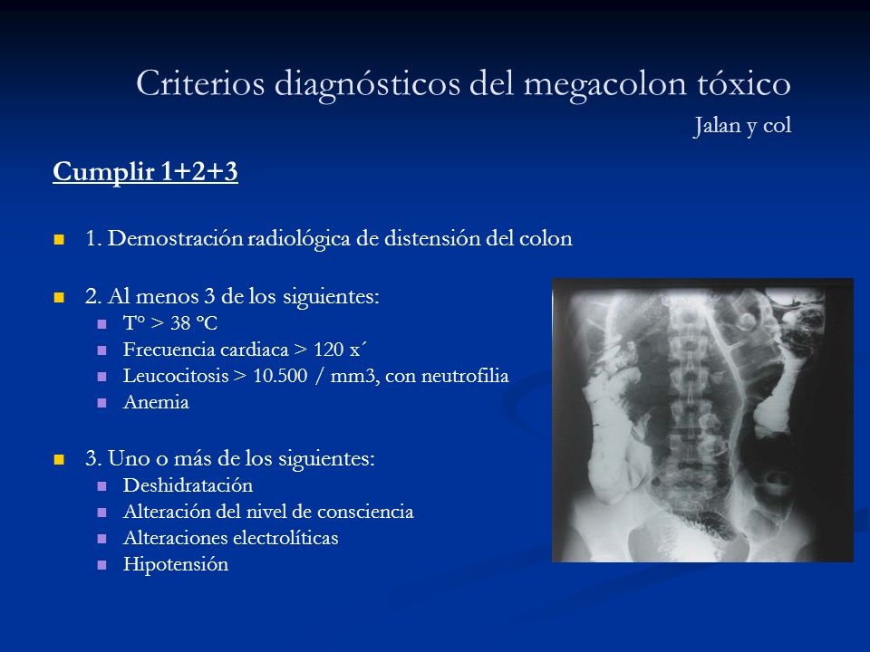Que es un megacolon toxico Que es un megacolon toxico
